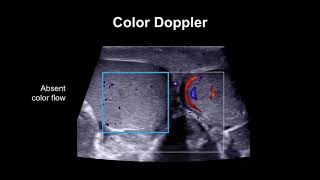 Breast Ultrasound Lesion Assessment BIRADS Ultrasound [upl. by Luann]