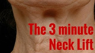 Botox neck lift [upl. by Sofko]