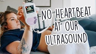 Fetal Distress Ultrasound and Heart Monitor [upl. by Zachery]