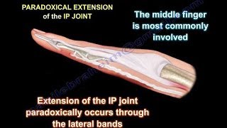 Lumbrical Plus Finger  Everything You Need To Know  Dr Nabil Ebraheim [upl. by Seaver305]