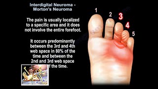 Interdigital Neuroma Mortons Neuroma  Everything You Need To Know  Dr Nabil Ebraheim [upl. by Nnayrb]