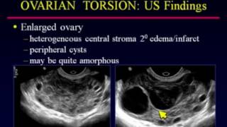 Ultrasound of Common Adnexal Cysts [upl. by Aisatal]