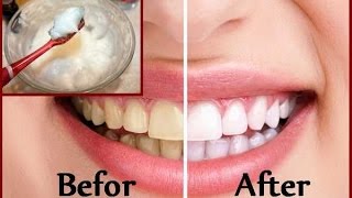 DIY Teeth Whitening at Home in 2 minutes [upl. by Ramal570]