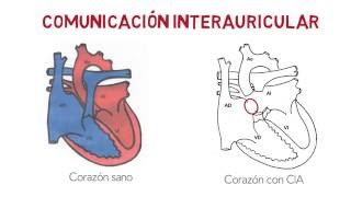 CIA  Comunicación interauricular [upl. by Ativ]