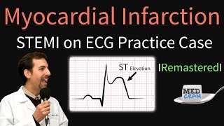 Myocardial Infarction  STEMI on ECG  Practice EKG [upl. by Hally]