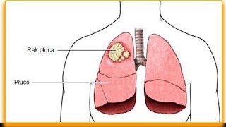 Jak się objawia rak płuc — objawy które powinieneś znać [upl. by Hogg]