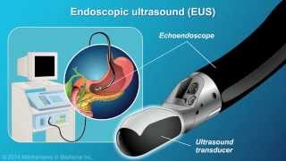 Understanding EUSFNA [upl. by Sosanna980]