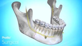 BSSO  Lower Jaw Advancement Surgery [upl. by Okramed302]