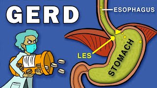 Gastroesophageal Reflux Disease GERD [upl. by Etiam793]