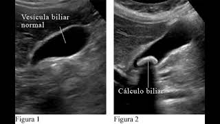 VESÍCULA BILIAR VALORACIÓN ECOGRÁFICA [upl. by Dawson864]