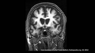 Huntingtons Disease [upl. by Stoll]