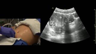 Sonographic Evaluation of Ovarian Torsion [upl. by Idleman970]