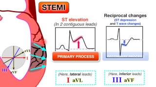 Ischemia 67  STEMI on ECG [upl. by Goran]