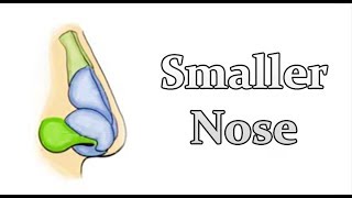 Pinched Narrow Nose Rhinoplasty to Address Nasal Obstruction [upl. by Lledroc]