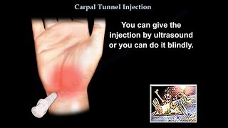 Carpal Tunnel Syndrome  Everything You Need To Know  Dr Nabil Ebraheim [upl. by Blanc842]