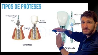 Tipos de prótese em Implantodontia  Cimentadas Parafusadas Unitárias ou Múltiplas [upl. by Massimiliano]