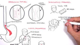 GORD GERD Gastro Oesophageal Reflux Disease  Overview pathophysiology treatment [upl. by Ettigirb188]