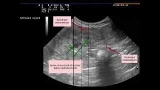 Endometritis  CRASH Medical Review Series [upl. by Dorothea]