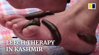 Kashmir residents seek leech therapy on Navroz [upl. by Adnema]