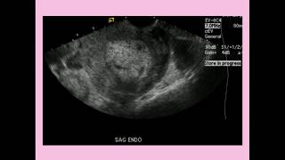 Webinar Replay How to diagnose Endometriosis on Ultrasound [upl. by Bertina]