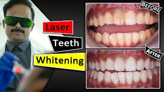 Teeth Whitening With Laser  Fastest amp Safest way [upl. by Atinaej]