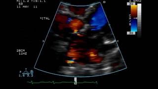 Atrial Septal Defect ASD USMLE Step 1 Pathophysiology [upl. by Jacenta480]