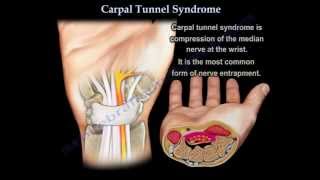 What to expect during a Carpal Tunnel exam with Brian A Pinsky MD FACS [upl. by Bern946]