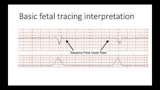 Key screening views of the fetal heart  Part 3  4chamber view [upl. by Adran]