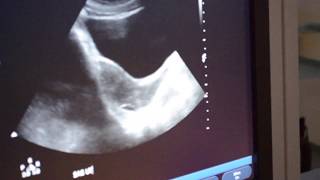 Diagnostic Hysteroscopy  Generalized Endometritis [upl. by Tshombe]