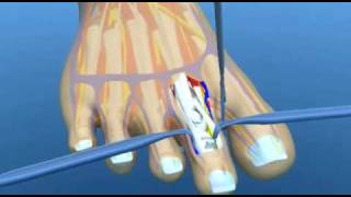 Hammer Toe Surgery Explained Podiatry Claw Toe Mallet Toe [upl. by Moffitt]