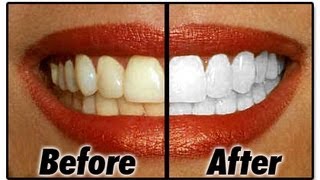 How I Whiten My Teeth At Home [upl. by Imotas]