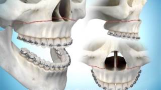 Maxillary Advancement Surgery [upl. by Dolphin]